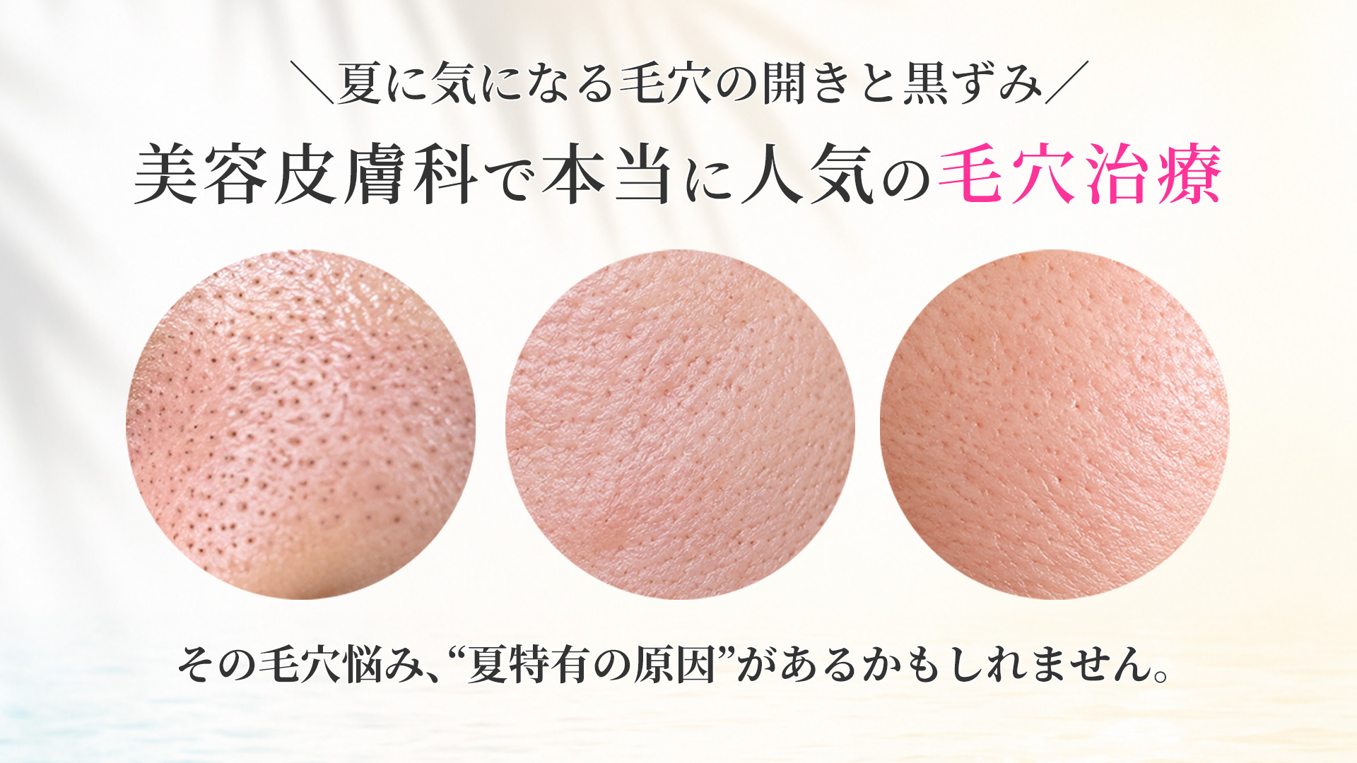 美容皮膚科で人気の毛穴治療