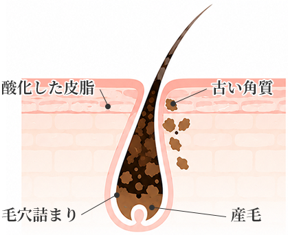 毛穴の黒ずみの正体