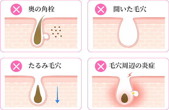毛穴ケアはホームケアだけでは難しいことも