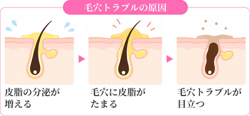 毛穴トラブルの原因